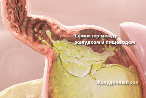 Изжога и её причины