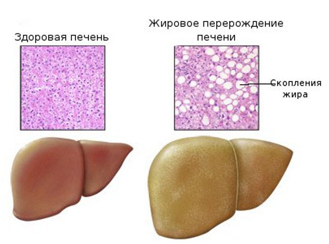 Жировая болезнь печени: что это и как себя уберечь?