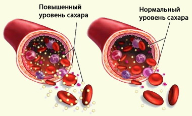Какие бывают осложнения при диабете